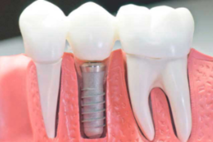 Implantes dentales